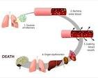 Sepsis Stages