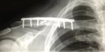 clavicle plated.jpg