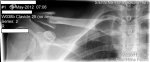clavicle_xray_2_may.jpg