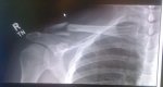 clavicle_xray_jun.jpg