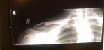 clavicle_xray_3.jpg